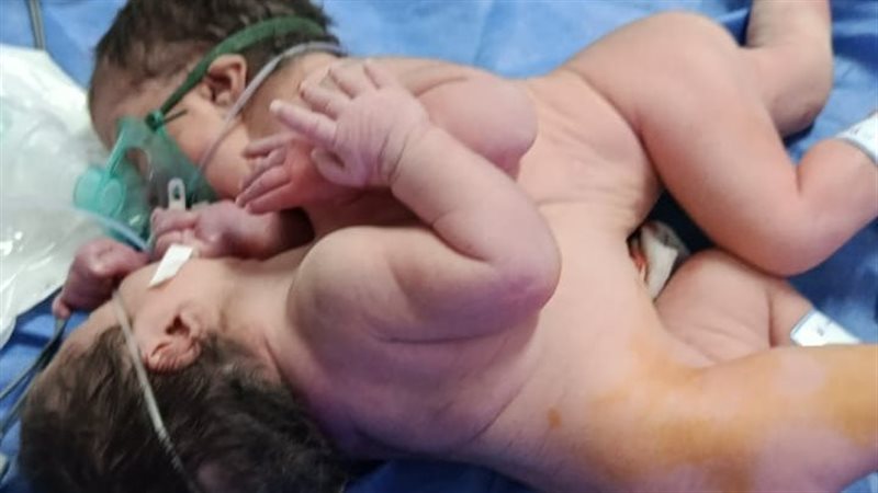 ولادة نادرة لتوأم