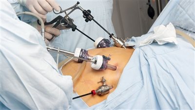 عملية تحويل مسار المعدة الحل الأمثل للتخلص من السمنة وعلاج مرض السكري 