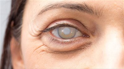 ما هي مضاعفات المياه البيضاء؟ الأعراض والمخاطر والعلاج