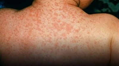 التهاب السحايا.. أنواع وأسباب الإصابة وكيفية الوقاية منه