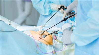 سعر استئصال المرارة بالمنظار في مصر.. خيار آمن بتكلفة مناسبة