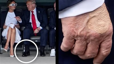 القصور الوريدي .. 20 معلومة عن مرض الرئيس الأمريكى | فيديو