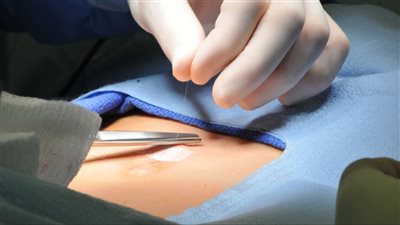 كل ما يجب معرفته عن عملية الفتق السري مع تركيب الشبكة