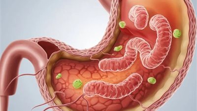 جرثومة المعدة تهدد صحتك في صمت.. تعرف على الأعراض والمضاعفات والعلاج