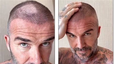 الأمر يبدوا فظيعا.. فكتوريا تفضح بيكهام بسبب «البقعة الصلعاء»| صور 