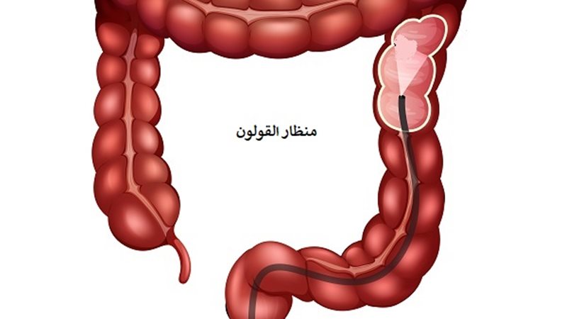 القولون العصبي