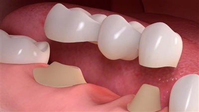 ما حكم بيع الأسنان المخلوعة للأطباء وطلاب كليات الطب؟ الإفتاء توضح