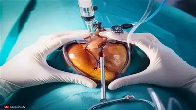 كل ما تريد معرفته عن عملية القسطرة ونصائح لتجنب المضاعفات