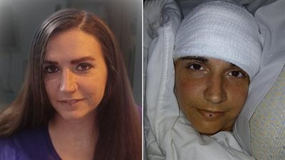 بعد 20 عامًا من الشلل.. امرأة تستعيد القدرة على الكتابة بفضل شريحة «نيورالينك»