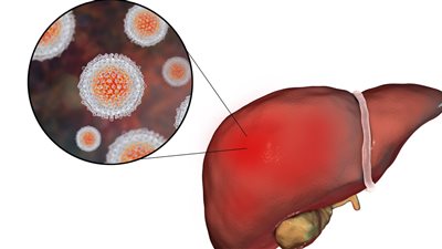 دراسة: فيروس الالتهاب الكبدي C يهدد المواليد الجدد ويسجل آلاف الإصابات عالميًا