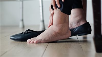 طرق فعالة لعلاج تورم القدمين خلال الصيف والتخفيف منه  