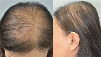 الصلع وتساقط الشعر أزمة صحية ونفسية كشفتها شجاعة رحمة حسن 