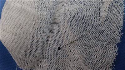 فريق طبي بجامعة المنوفية ينقذ فتاة من اختناق حاد بسبب دبوس حجاب