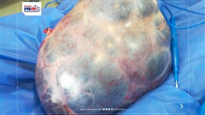 مستشفى أبشواى ينجح فى استخراج ورم وزنه 7 كيلو من بطن مريضة بالفيوم 