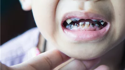 كيف تحمي أسنانك من التسوس أثناء تناول حلويات المولد؟.. إليك أبرز النصائح