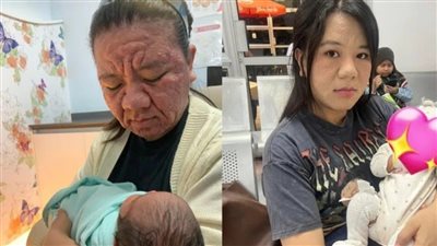 كبرت 40 سنة.. ماليزية 28 عاما تُعانى من تغيرات حادة فى مظهرها أثناء الحمل