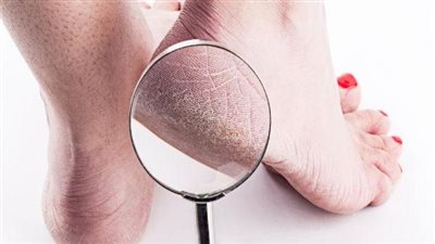 منها زيت الزيتون والسكر الخشن والعسل..حلول سحرية للقضاء على تشقق الكعبين