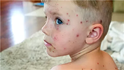 «صحة البحر الأحمر» تنفي شائعة الانتشار: لم نسجل سوي  3 حالات للجدري المائي