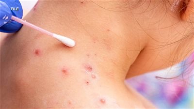 بعد تفشي المرض.. وفاة طفل يبلغ من العمرعامين بسبب الحصبة في إسرائيل