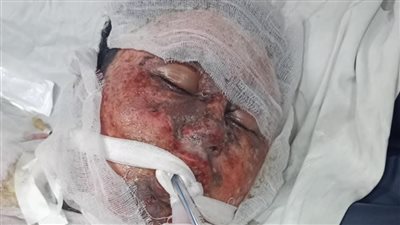 استجابة لـ «نيوز روم».. نقل الشاب المصاب بحريق شبرا إلى مستشفى أهل مصر