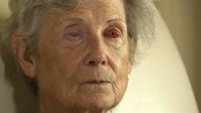 عملية جراحية تعد الأغرب.. إعادة البصر لكفيفة بزرع سن في عينها