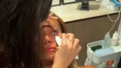 تجربة غريبة.. عارضة أمريكية تثير الجدل بعدسات من المشيمة لعلاج العين