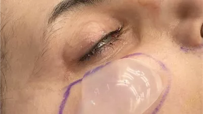 زرع غمازات الخدين.. موضة تجميلية تنتشر بصورة سريعة