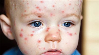 الطفح الجلدي عند الأطفال: طرق فعالة للعناية ببشرة طفلك في الصيف 
