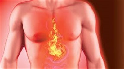 حرقان المعدة.. أسبابها الحقيقية وأفضل العلاجات المنزلية الفعّالة