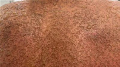 كان فى حالة حرجة.. مستشفى الدولى بالمنصورة تنقذ مريض بمتلازمة ستيفنز جونسون 