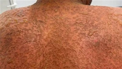 إنقاذ مريض ستيني مصاب بمتلازمة ستيفنز جونسون في مستشفى المنصورة الدولى