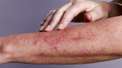 بعد إنقاذ مريض مصاب بمتلازمة ستيفنز جونسون بالمنصورة.. أعراض وعلاج هذا المرض