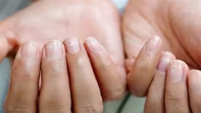 5 علامات خطيرة على أظافرك قد تكشف أمراض القلب والكبد وتصل إلى السرطان