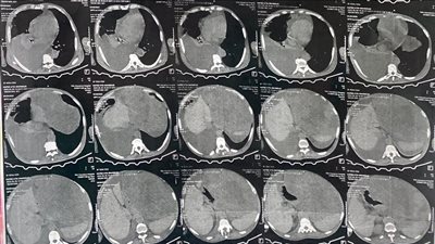 إنقاذ مريض بعد استئصال ورم وزنه 15 كجم بمستشفى النيل للتأمين الصحي بالقليوبية