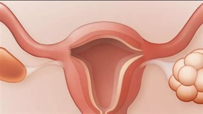 دليلك الشامل لفهم تكيسات المبايض.. الأعراض والعلاج والوقاية منه