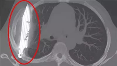 صدمة في تنزانيا رجل عاش بسكين في صدره لمدة 8 سنوات دون أن يدري