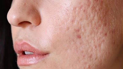 الدليل الشامل لعلاج حب الشباب عند البالغين:الأسباب والعلاجات الفعالة والمحظورة