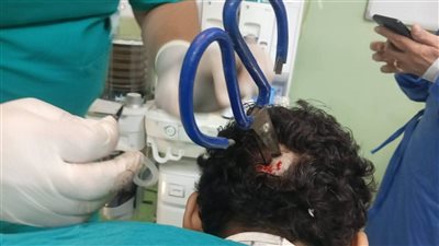 معجزة طبية في بنها.. إنقاذ مريض من الموت بعد استخراج مقص من جمجمته