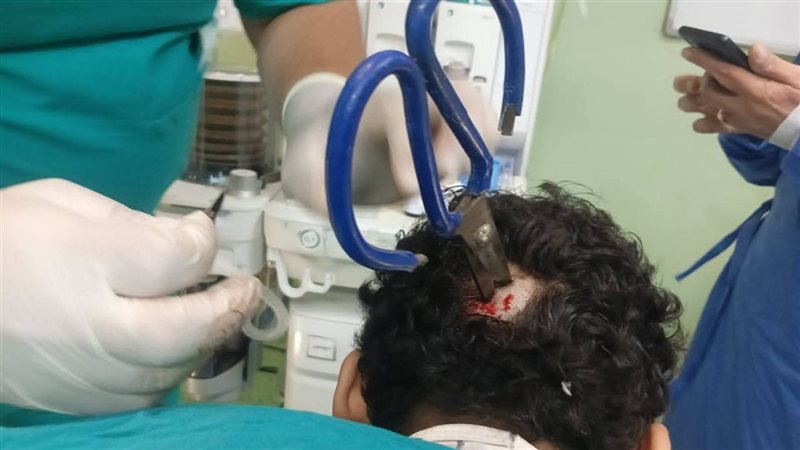 استخراج مقص من نجمة