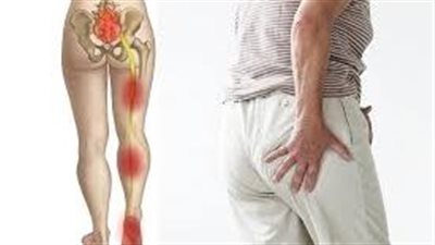 آلام عرق النسا كيف تحدث وأفضل الطرق للتخفيف من أعراضها