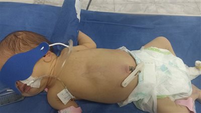 إنقاذ حياة طفلة رضيعة تعاني من انسداد معوي بالمنوفية