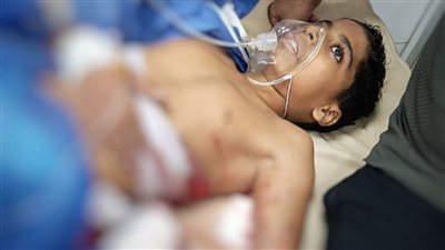 إصابة طفل بطلقات خرطوش خلال مروره بجوار مشاجرة بزهور بورسعيد