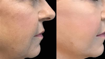 اسألي الطبيب.. حكم إجراء عملية شد الوجه لإزالة التجاعيد؟