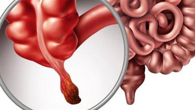 التهاب الزائدة الدودية.. الأعراض والأسباب وطرق العلاج