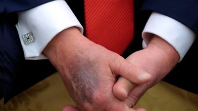 كدمات ترامب تثير الجدل.. ما تفسير الأطباء لظهورها المتكرر؟