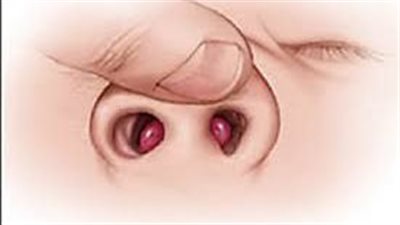 استشاري طب الأطفال يكشف أسباب انسداد الأنف وطرق العلاج.. فيديو