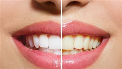 وصفات طبيعية وفعّالة لتبيض الأسنان في المنزل «ابتسامتك هتنور من جديد»