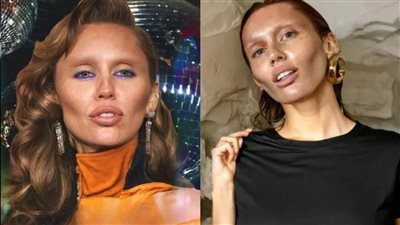 مايلي سايرس تثير الجدل بتغير ملامحها.. وأطباء التجميل يكشفون الحقيقة