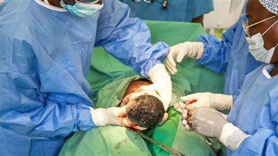 تحذير من الإفراط في العمليات القيصرية.. و«الصحة» تدعو لتصحيح المفاهيم