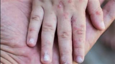 مع اقتراب دخول المدارس.. كيف تحمي طفلك من مرض الحصبة؟